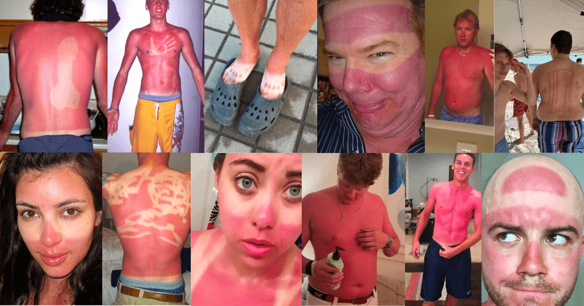 The Accidental Art of Sunburn: A Humorous Look at Photoprotection Failures and the Serious Science Behind Them | Doctor Grilo Dermatologist