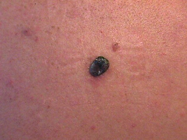 Nodular Melanoma