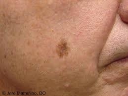 Lentigo Maligna Melanoma on a person's cheek