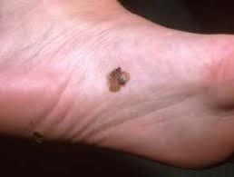 Acral Lentiginous Melanoma on the sole of a foot