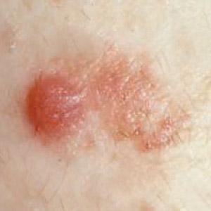 Amelanotic Melanoma, a pinkish skin lesion