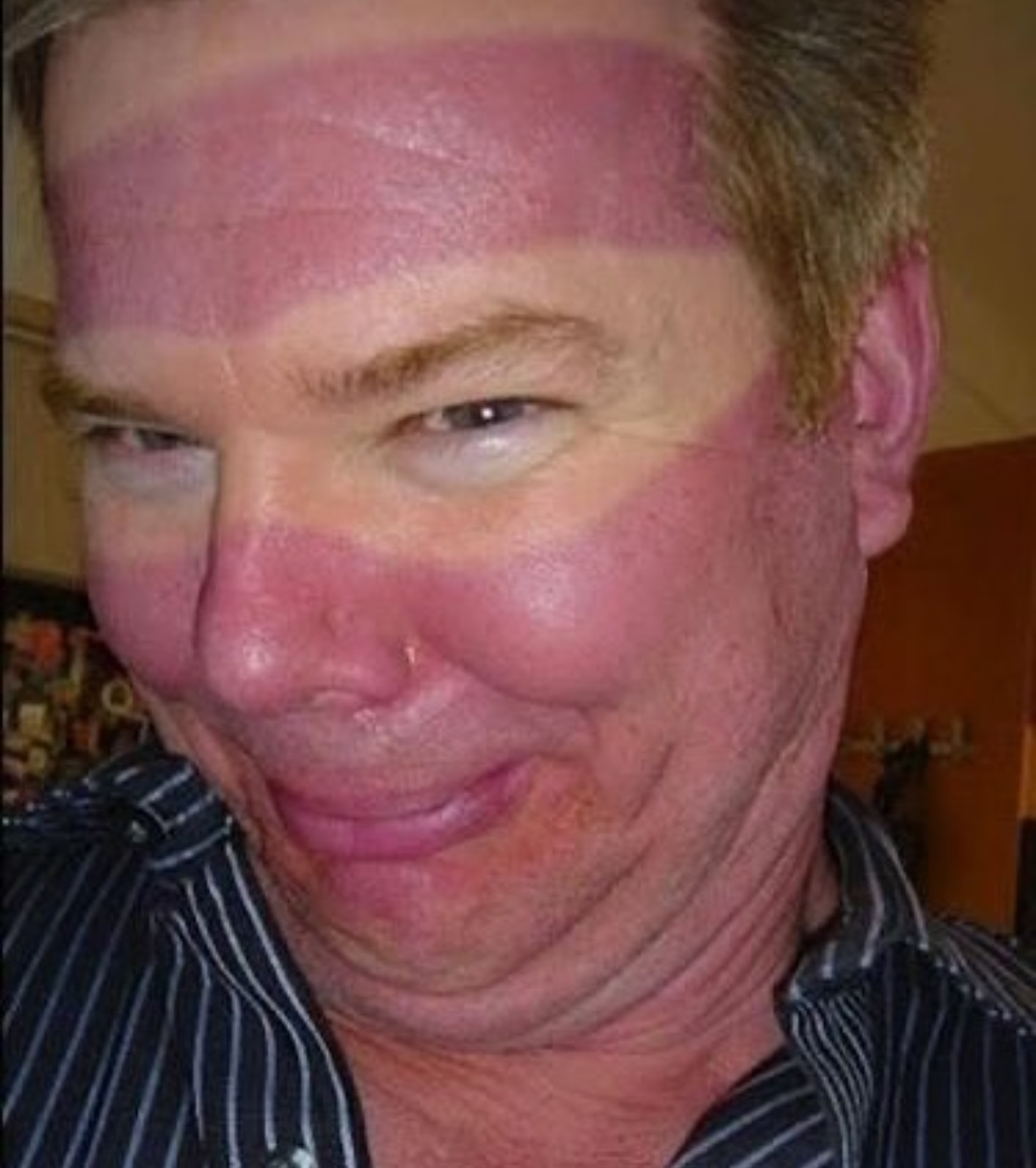 The Sunglass Tan | The Accidental Art of Sunburn: A Humorous Look at Photoprotection Failures and the Serious Science Behind Them)