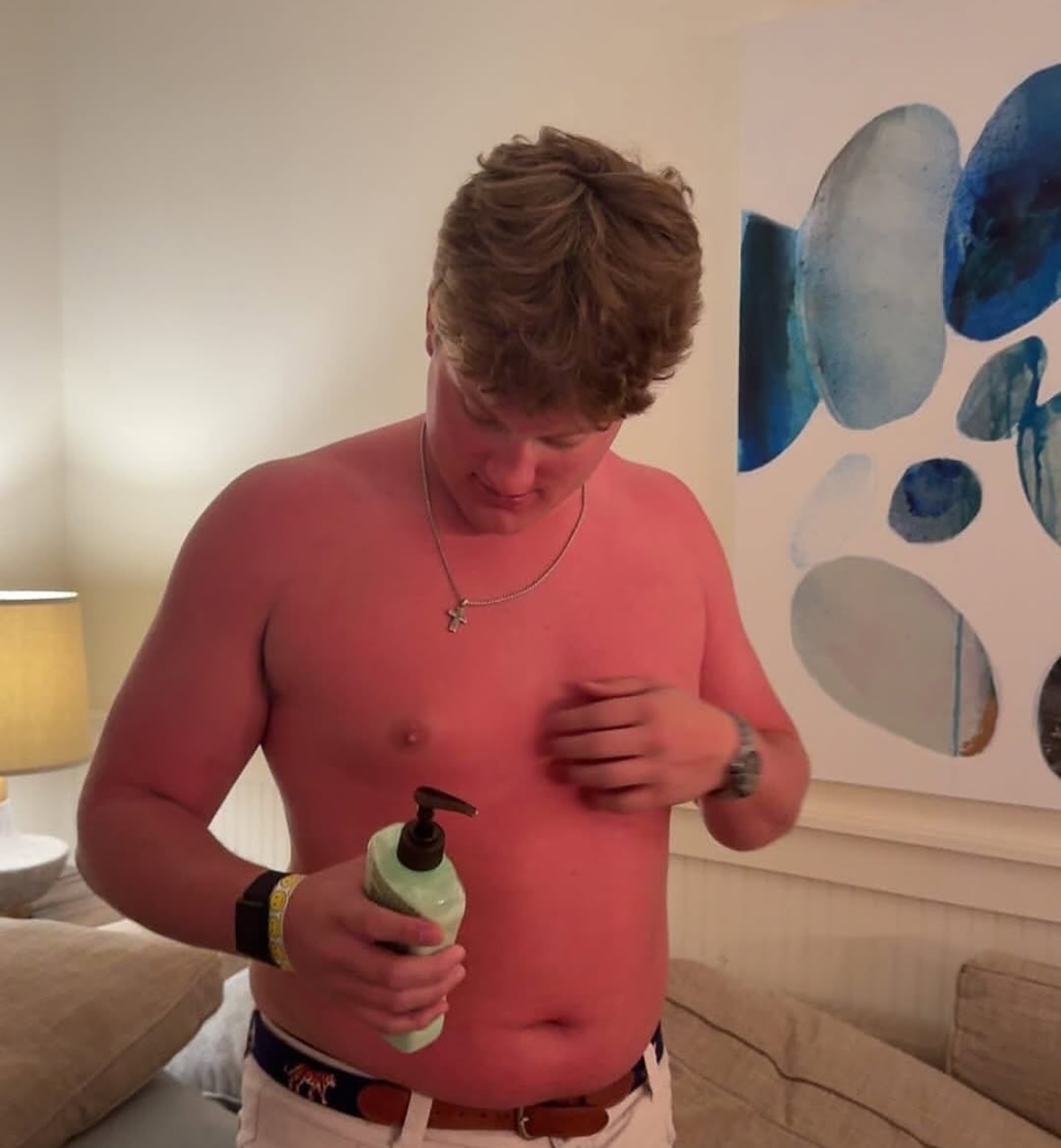 The Lobster | The Accidental Art of Sunburn: A Humorous Look at Photoprotection Failures and the Serious Science Behind Them)