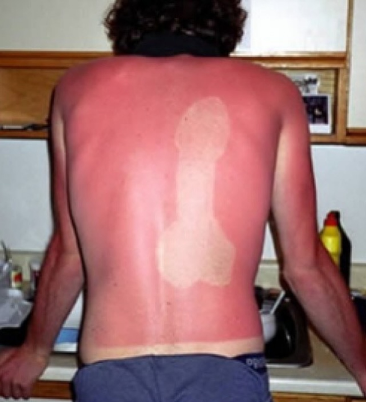 The Stupid Shape Burn | The Accidental Art of Sunburn: A Humorous Look at Photoprotection Failures and the Serious Science Behind Them)