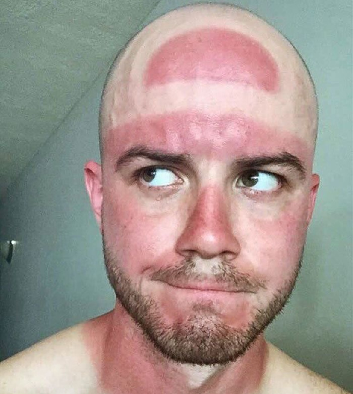 The Logo Burn | The Accidental Art of Sunburn: A Humorous Look at Photoprotection Failures and the Serious Science Behind Them)