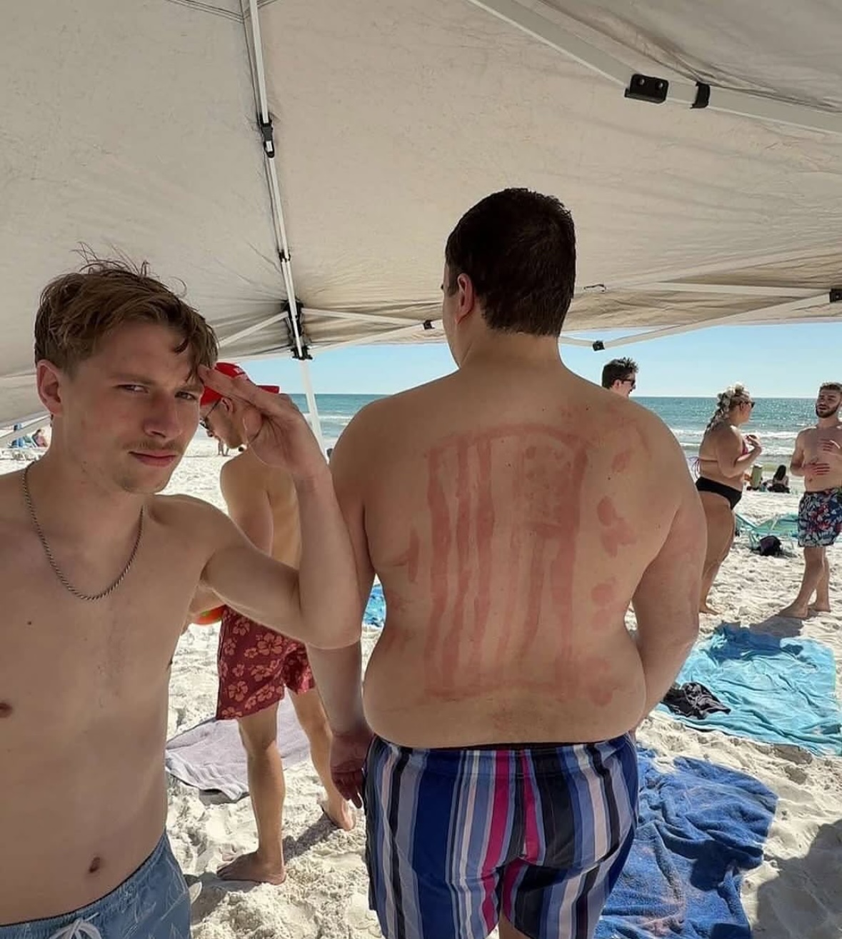 The Stupid Shape Burn | The Accidental Art of Sunburn: A Humorous Look at Photoprotection Failures and the Serious Science Behind Them)