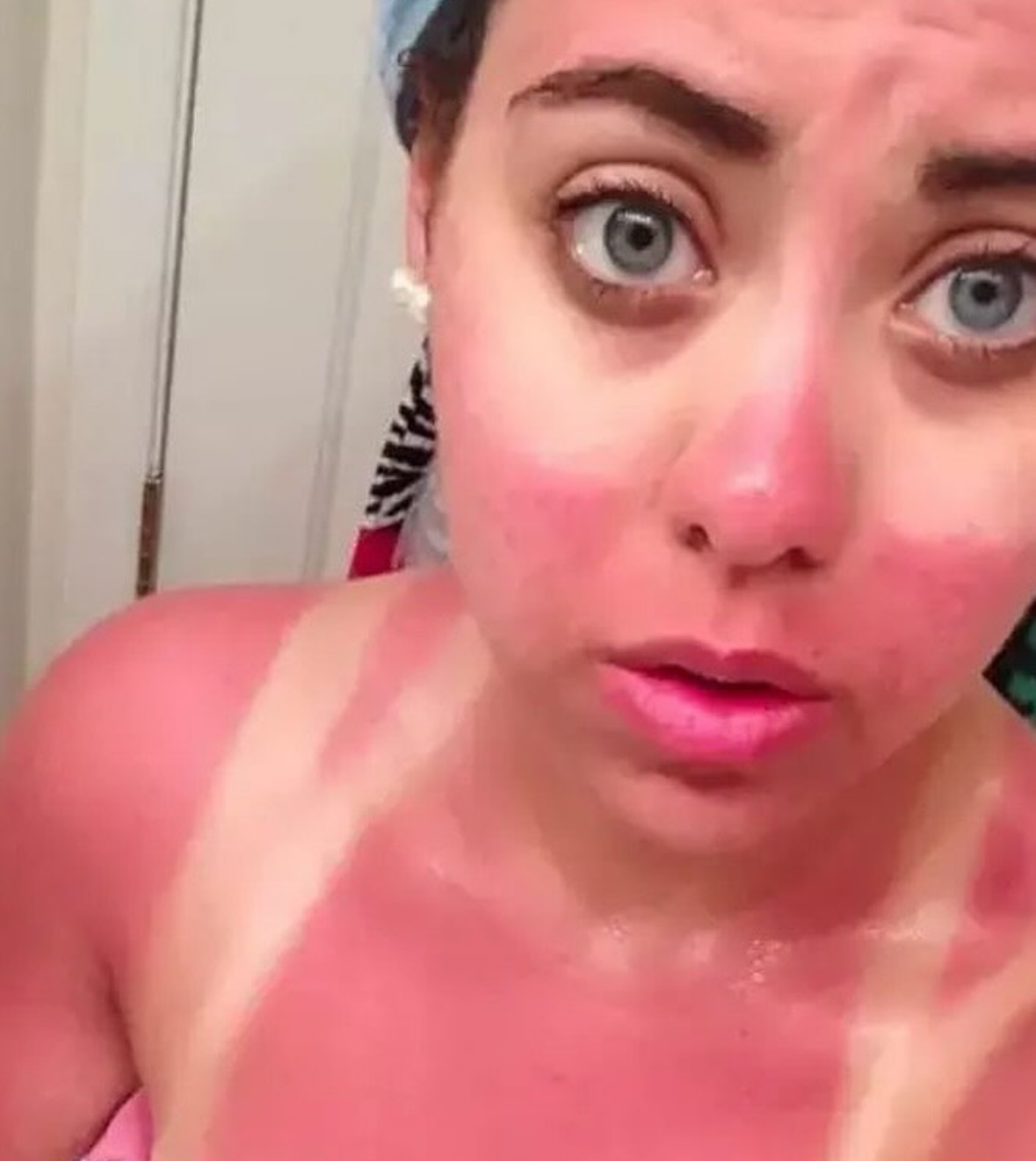 The Strappy Swimsuit Grid | The Accidental Art of Sunburn: A Humorous Look at Photoprotection Failures and the Serious Science Behind Them)