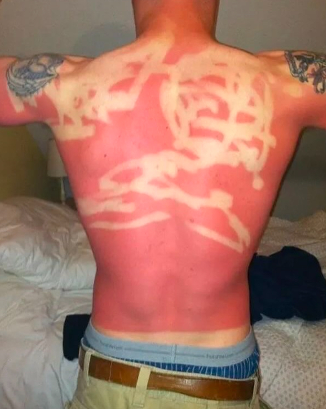 The Abstract Expressionist (a.k.a. Streaky Roll-On Application) | The Accidental Art of Sunburn: A Humorous Look at Photoprotection Failures and the Serious Science Behind Them)