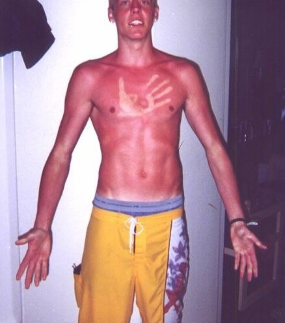 The Handprint of Shame | The Accidental Art of Sunburn: A Humorous Look at Photoprotection Failures and the Serious Science Behind Them)