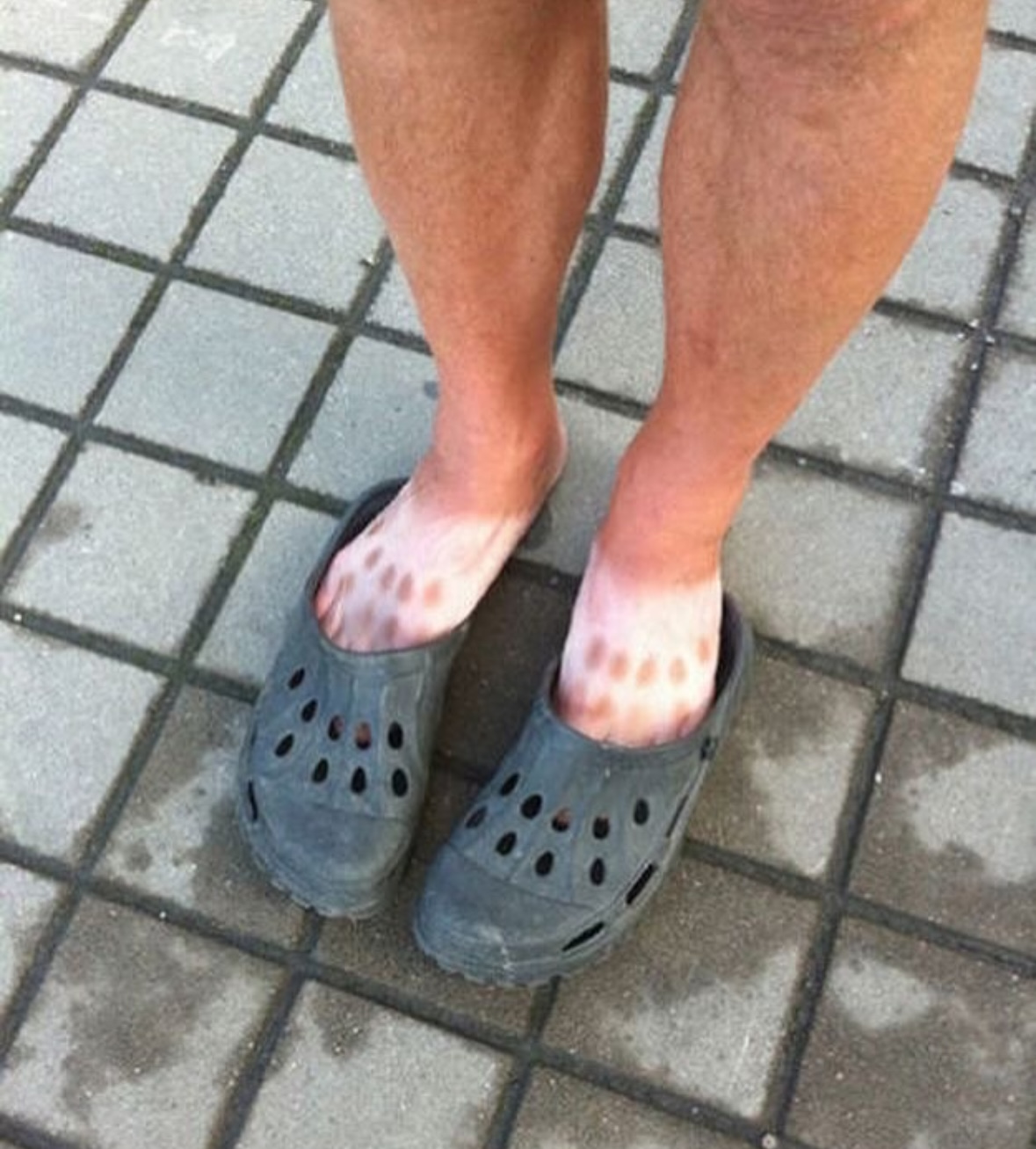 The Croc Foot Tan | The Accidental Art of Sunburn: A Humorous Look at Photoprotection Failures and the Serious Science Behind Them)