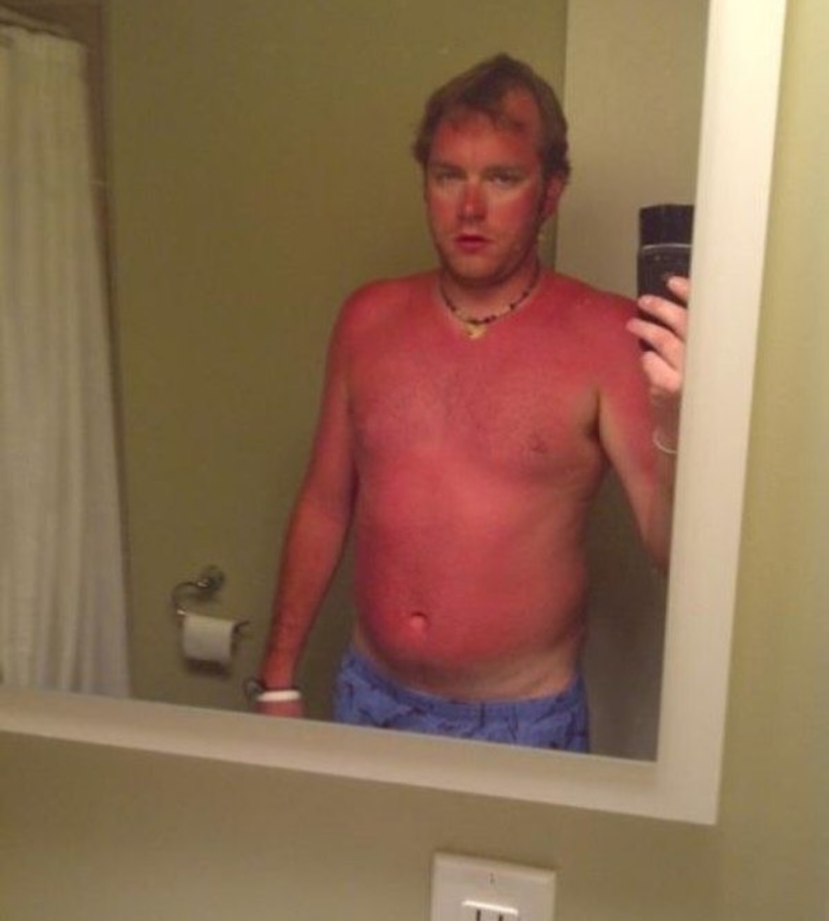 The Lobster | The Accidental Art of Sunburn: A Humorous Look at Photoprotection Failures and the Serious Science Behind Them)